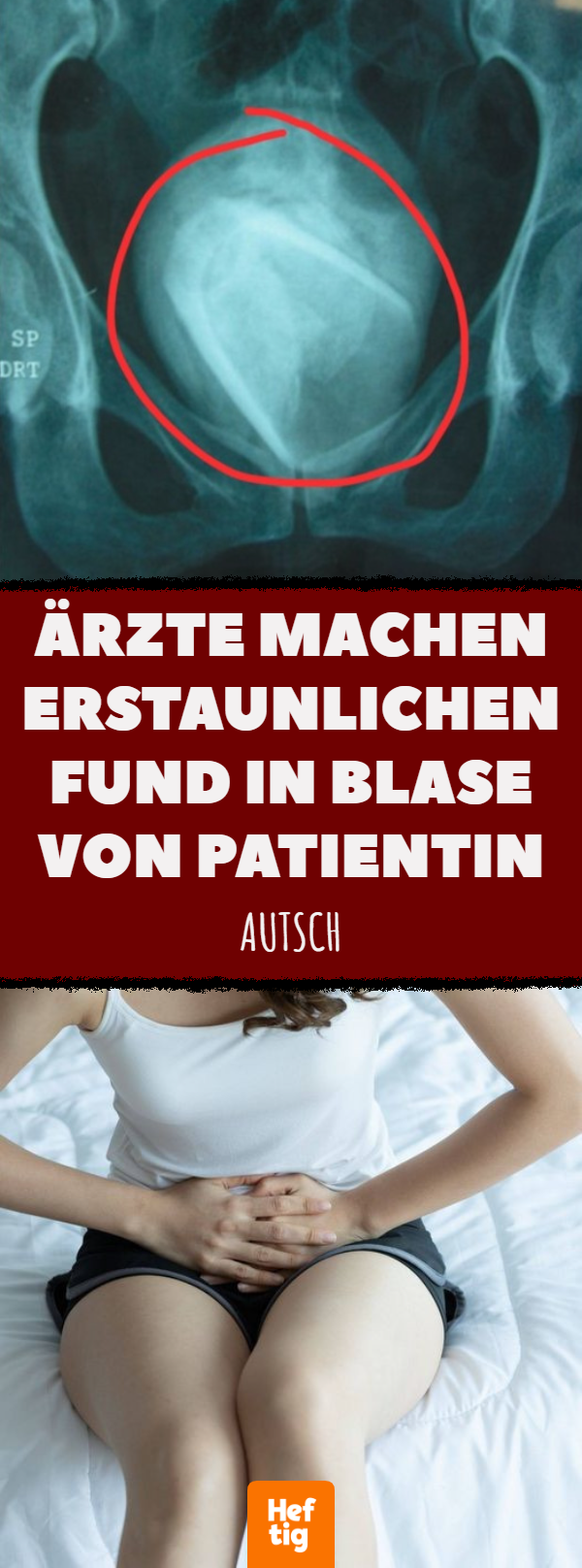 Ärzte machen erstaunlichen Fund in Blase von Patientin